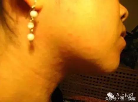 她年年吃螃蟹都没事，今年吃却满身长紫斑还尿血！为啥？