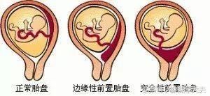 13周下缘达宫颈内口危险吗,13周胎盘下缘达内口