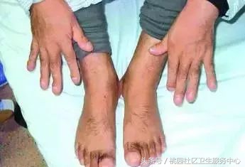 从脚看健康程度图解,从脚指甲颜色看身体健康