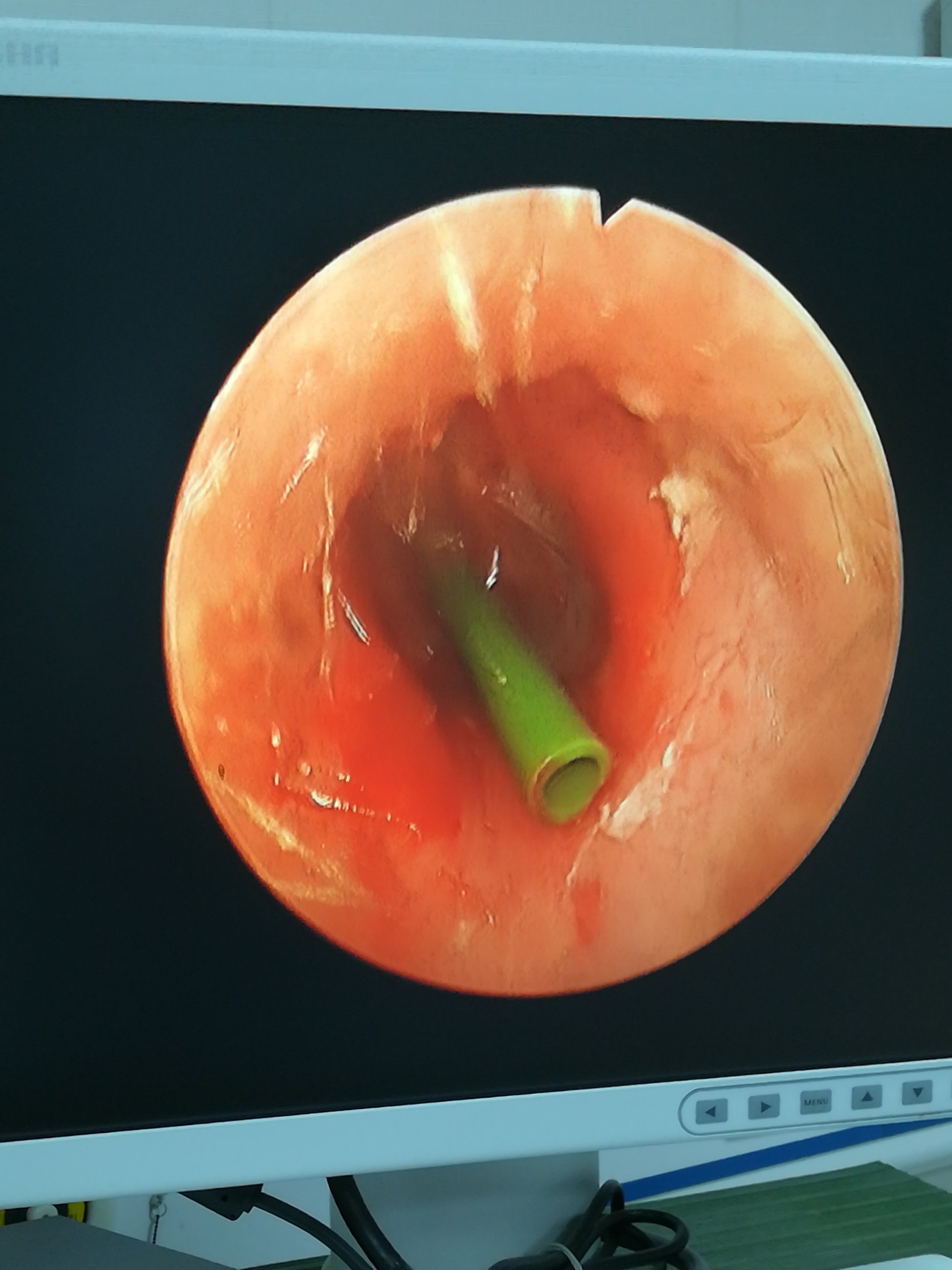 容易让爸妈忽略的小儿疾病中耳炎,怎么判断分泌物性中耳炎