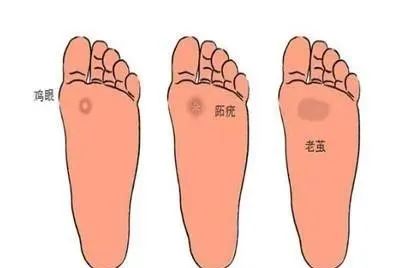 6岁儿童丝状疣怎么治疗,小孩子得寻常疣是什么原因造成的