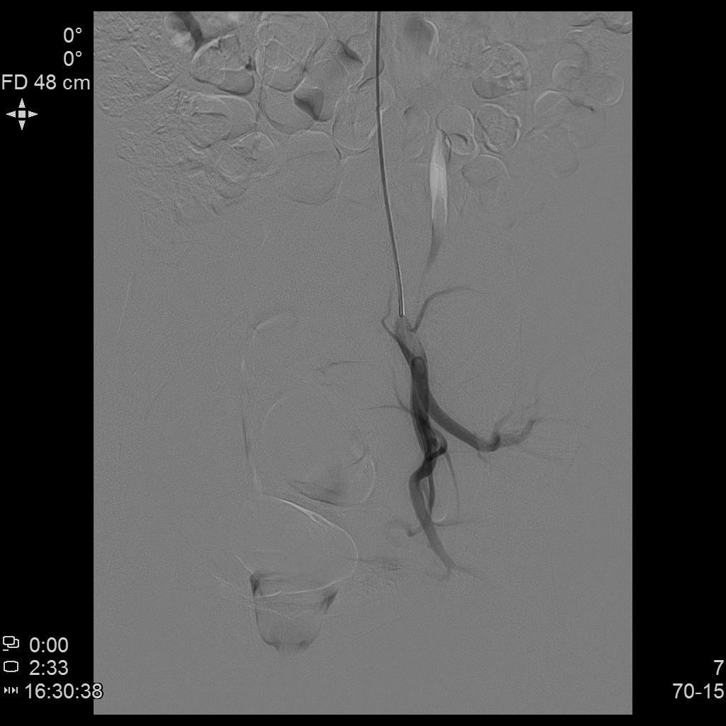 子宫肌瘤不能开刀只能化疗严重吗,子宫肌瘤介入栓塞治疗后注意事项