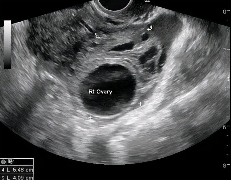 生完娃体检出现卵巢囊肿,卵巢囊肿可以通过教育局体检吗