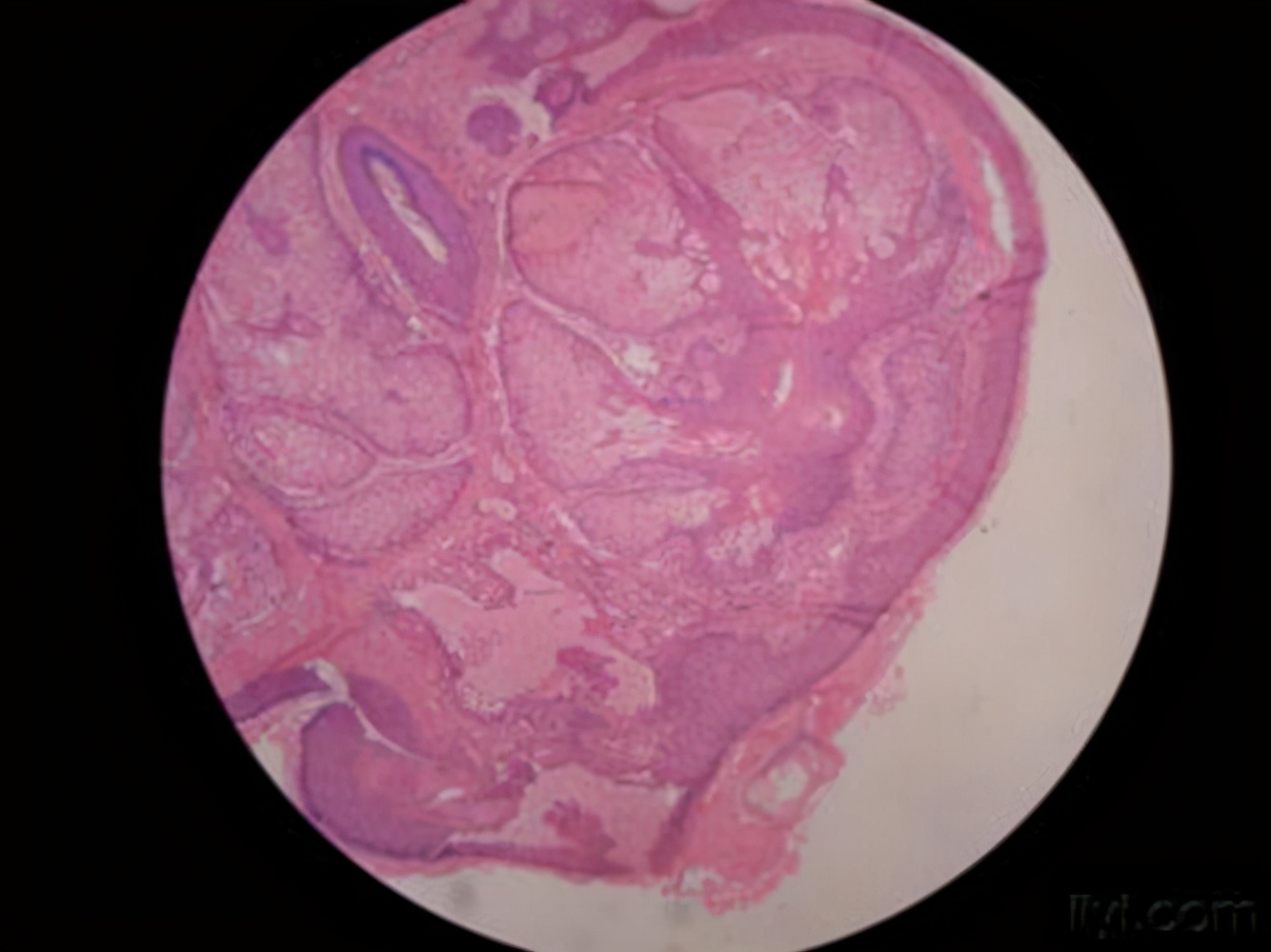 肿瘤来源于皮肤附属器是什么意思,皮肤附属器源性肿瘤能治好吗