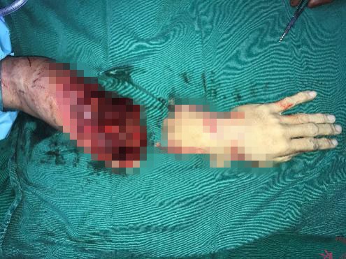 深圳市第二人民医院手足外科拯救东莞断臂伤者医生提醒--断肢千万不要泡水里！