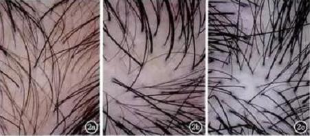 雄激素性脱发秃顶用什么能生发,雄激素性脱发科普