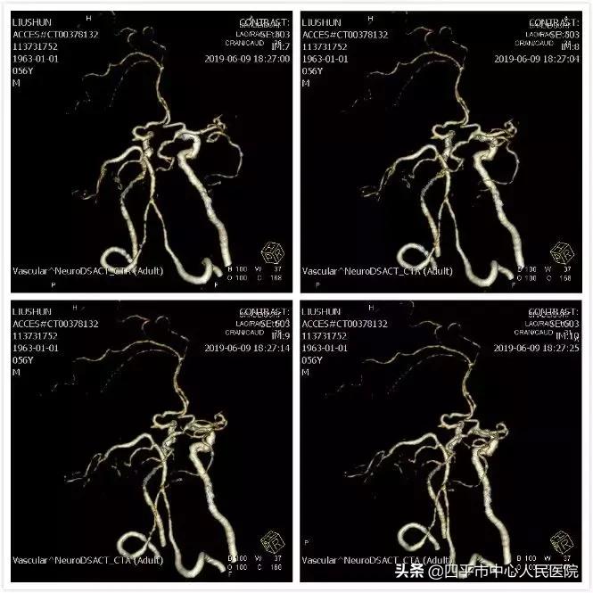 精准排雷再现新高—神经外科在6月份成功救治6例颅内动脉瘤患者