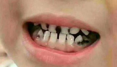 4岁宝宝刷牙牙也黄,宝宝刷牙为什么还是满口虫牙