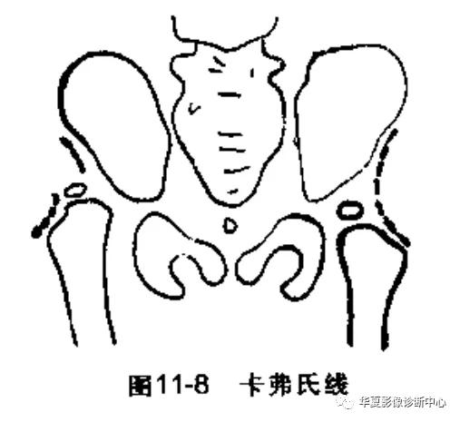 先天性髋关节脱位,先天性髋关节脱位属不属于残疾人