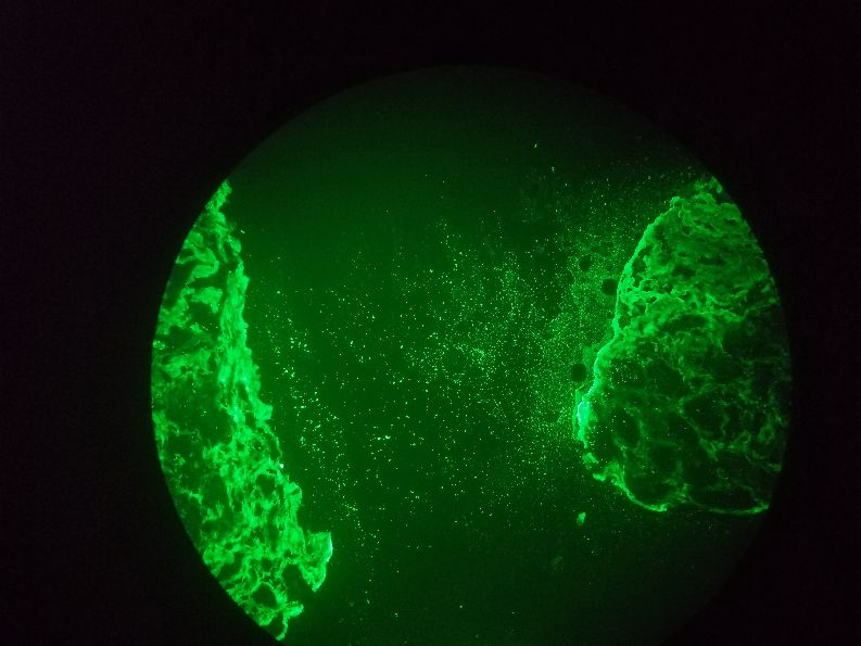 肾穿刺究竟有意义没有,肾穿刺后遗症有多可怕