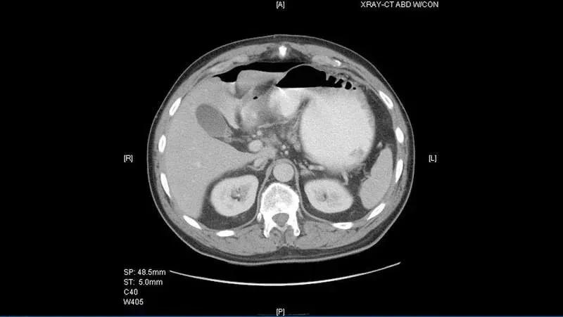 「病例挑战」男子每日饮酒，因胀气伴剧烈背痛入院治疗，咋回事？