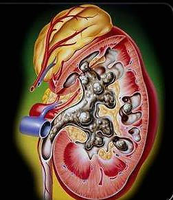 唐门的强大众所周知，唐门高手更是一流，这样的人也会得肾结石