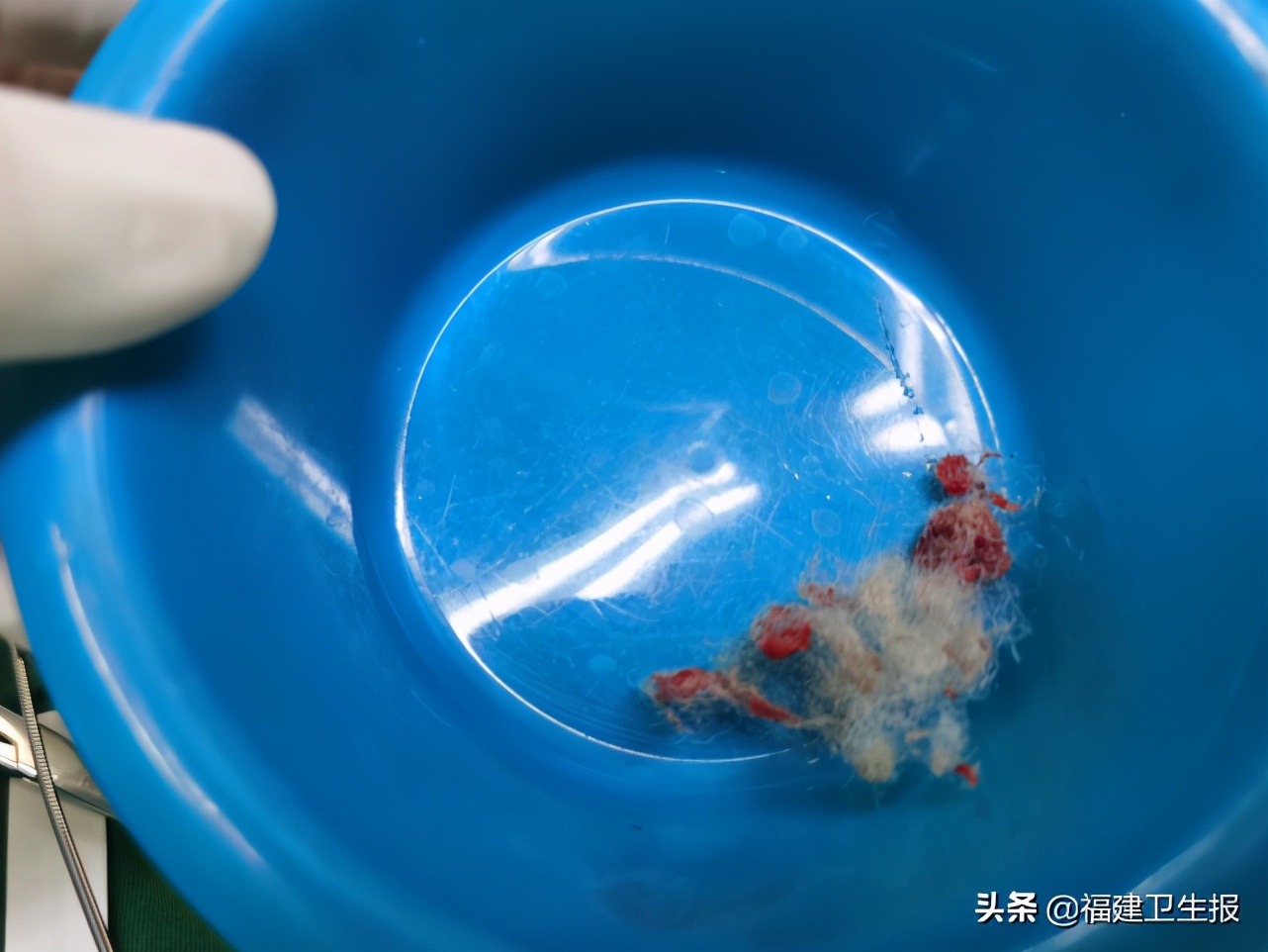 女幼童阴道炎会有什么症状,女幼童反复阴道炎怎么治疗