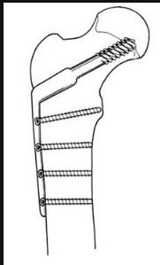 老年人骨折是什么骨折,老年人骨质疏松腰部骨折怎么办