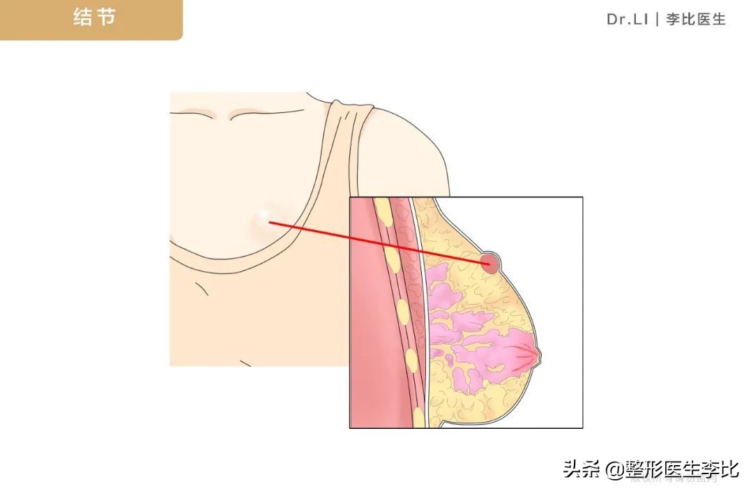 隆胸半年之后胸部有囊肿正常吗,脂肪隆胸以后胸部周围有小疙瘩
