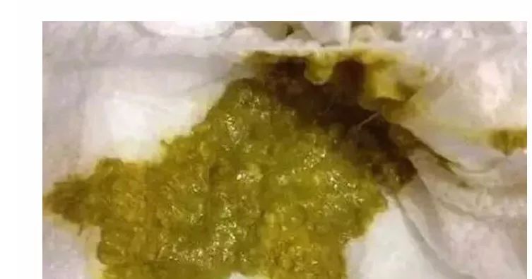 怎样判断新生儿宝宝大便是否正确,新生儿宝宝大便怎么判断是否正常