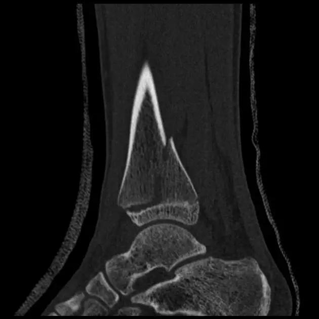 特殊骨折类型,特殊骨折体征