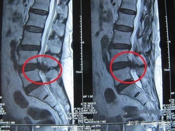 腰椎间盘突出怎么办,腰椎间盘突出屁股疼