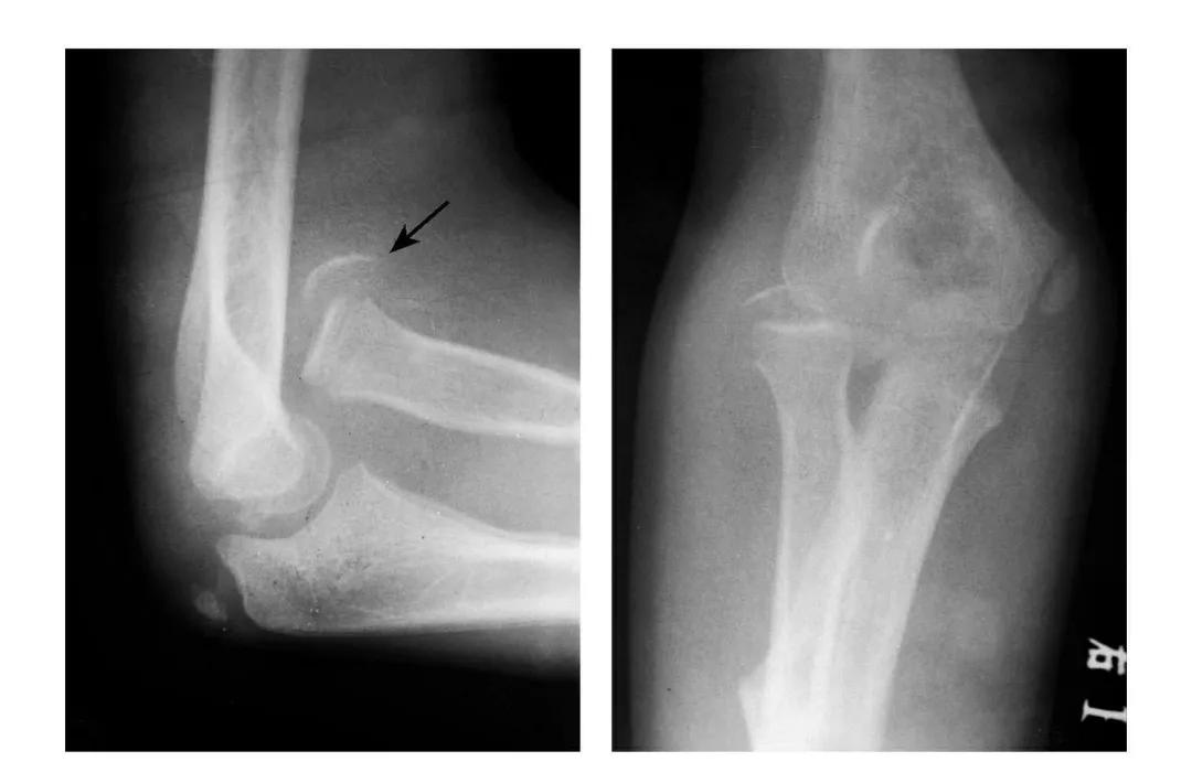 青少年肘部损伤最常见的是,肘部桡神经损伤的临床表现