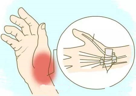 腱鞘炎大拇指怎么引起的,右手大拇指腱鞘炎最好的治疗方法