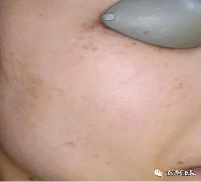 光子嫩肤帮你逆袭光滑细嫩状态,光子嫩肤让你拥有蛋壳般肌肤