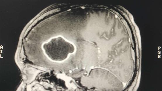 挤痘一时爽，挤完脑脓肿？|健康问答133期