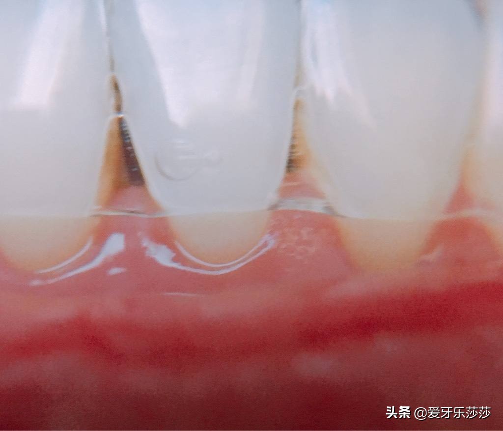 牙齿矫正后黑三角严重怎么办,儿童牙齿矫正会出现黑三角吗