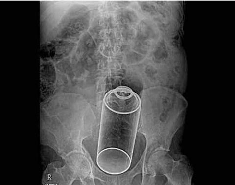 不作死就不会死，看看这些被人类搞进身体里的异物