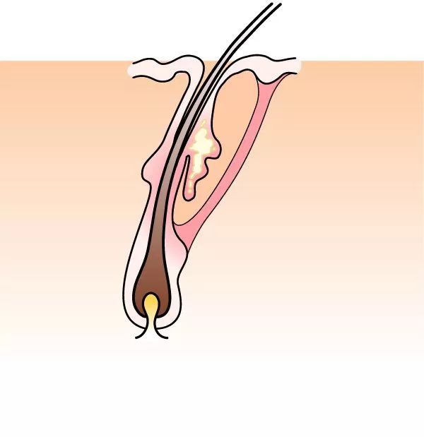 腿毛可以检测吸毒么,一根头发可以检测吸毒了吗
