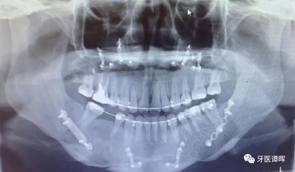 超详细的牙齿矫正过程,成人骨性牙齿矫正过程