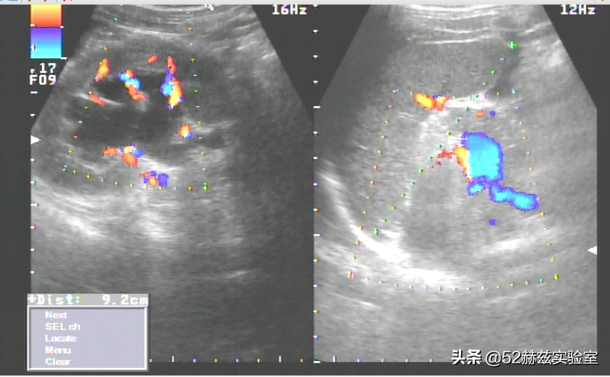 美国超声刀和德国超声刀,超声刀详细介绍