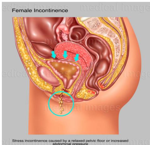 和睦家肖明月：让Ella尿*禁失**两年的生育后遗症，可以避免吗？