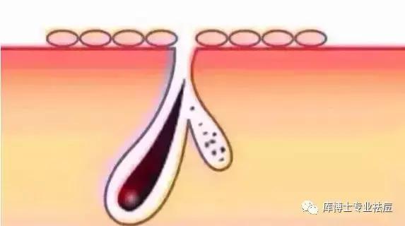 涂防晒霜爆皮,涂防晒霜就起疹子