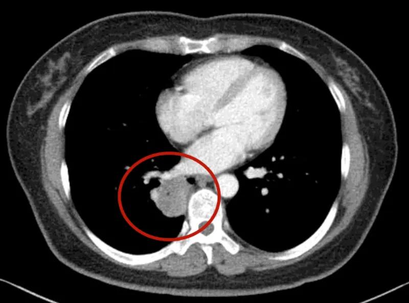 右肺下叶微小结节是什么意思,诊断报告左肺下微小结节没写大小