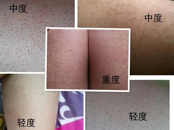 鸡皮肤痘印怎么治愈,鸡皮肤成因及如何去除