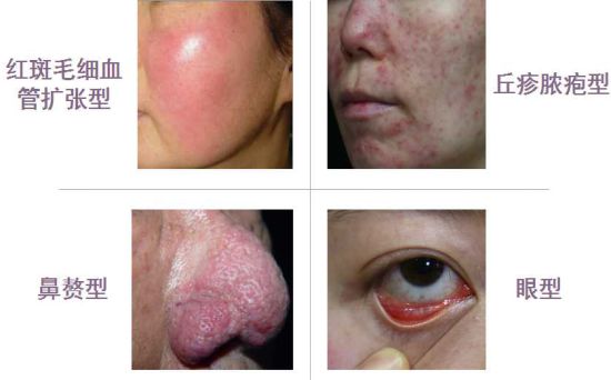 青春痘绝不仅仅影响颜值那么简单,青春痘可能只长一个吗