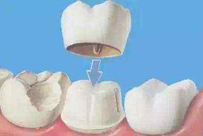 阿娇大龅牙,阿娇整牙