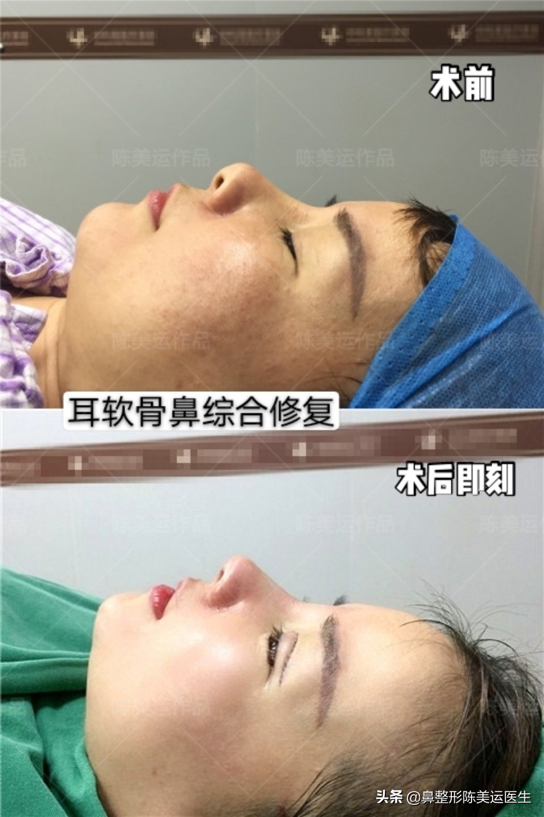 假体隆鼻后鼻子变歪该如何处理,假体隆鼻透光如何处理