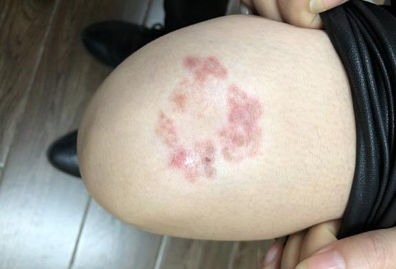 鑾妸绁炵粡鎬х毊鐐庡綋婀跨柟,鍒妸婀跨柟褰撶毊鑲ょ梾