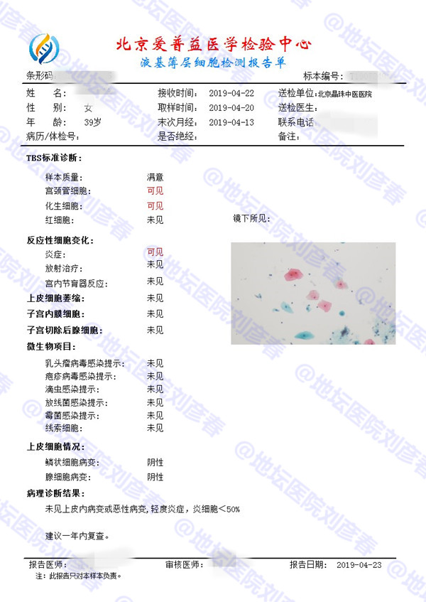 hpv感染多久会发生cin2级病变,hpv感染cin1病变塞药能好吗