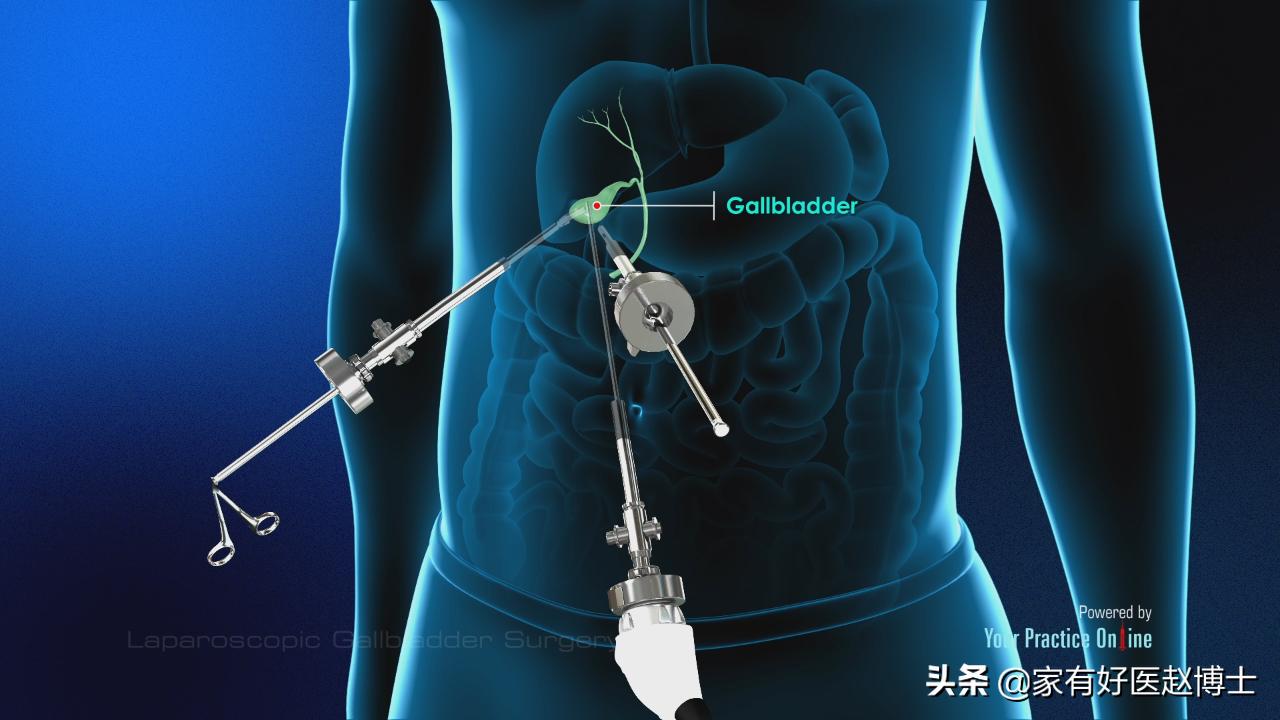 最常见5类息肉每个人都可能有，哪些无癌变风险，哪些需要切除？