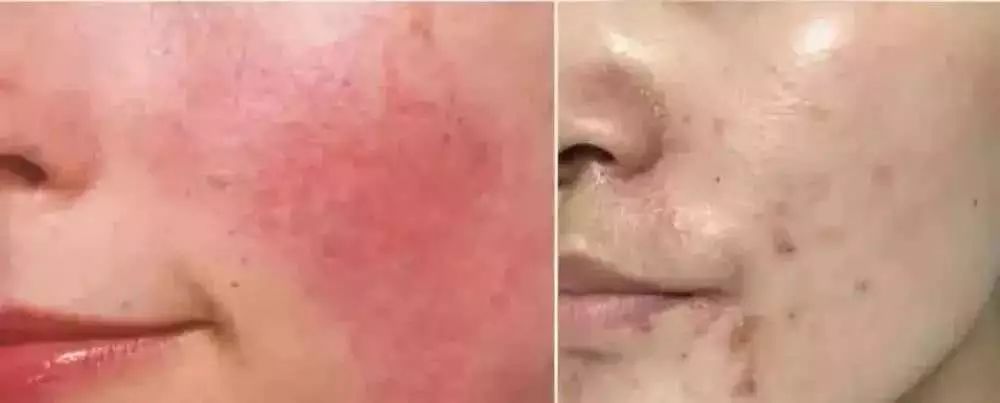 改善暗沉闭口粉刺敏感肌的水乳,如何拯救烂脸痘痘肌