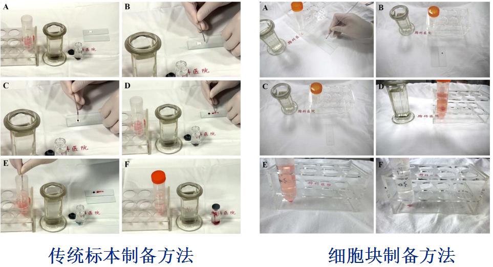 小细胞肺癌的气管镜介入治疗,导航支气管镜在肺癌诊断中的应用