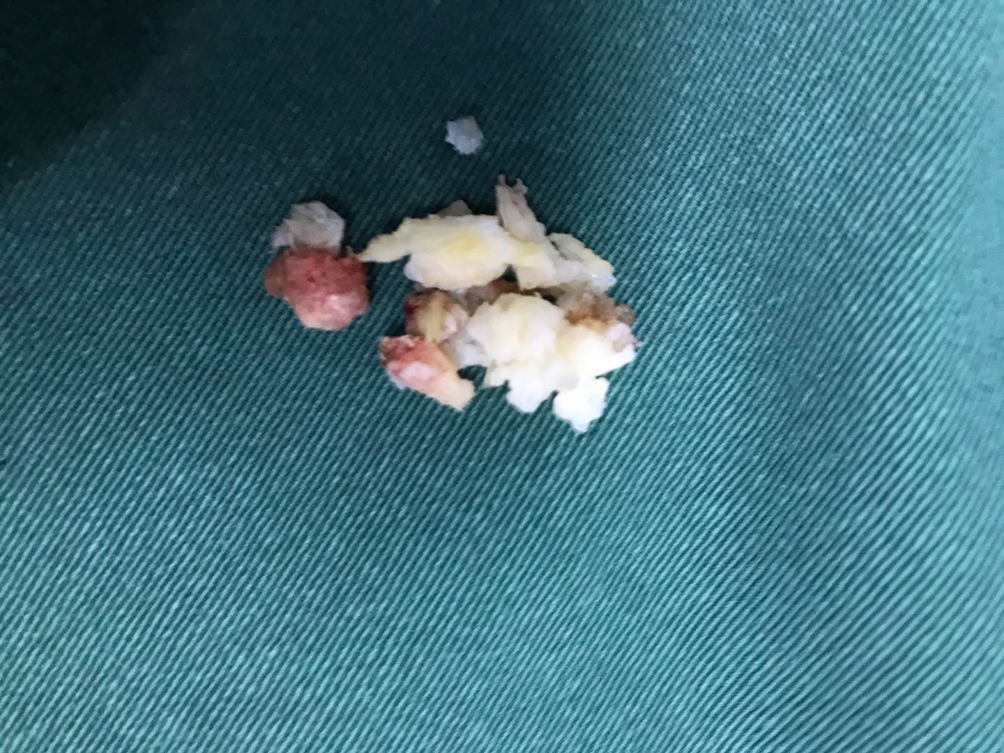 腰椎微创手术危险吗,腰椎微创手术有风险吗