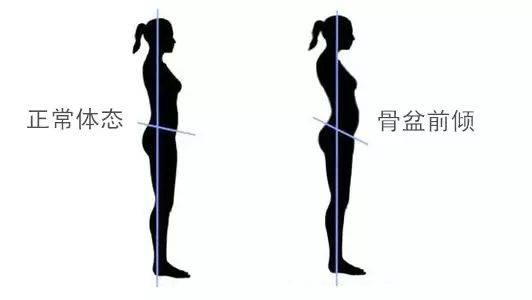 超膝伸肌肉腿怎么矫正,膝超伸和o型腿怎么改善