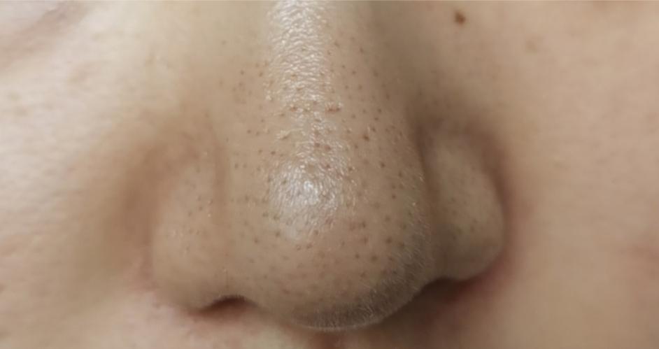 医生黑头粉刺去除的过程,怎么才能正确的去除黑头