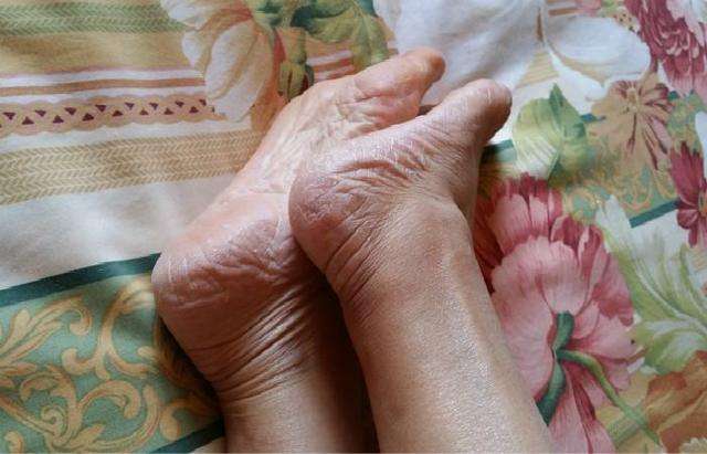 脚后跟干裂起皮的原因是什么,手心起皮和干裂是缺少维生素吗