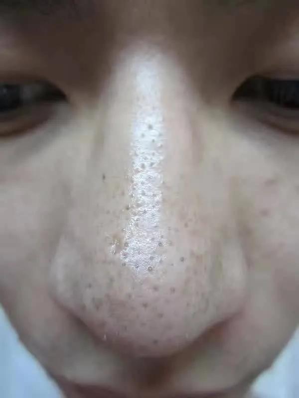 黑头镊子清理过程,专业黑头清理过程