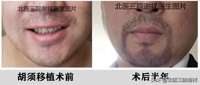 胡子种植可行吗需要注意哪些问题,胡子种植有什么讲究