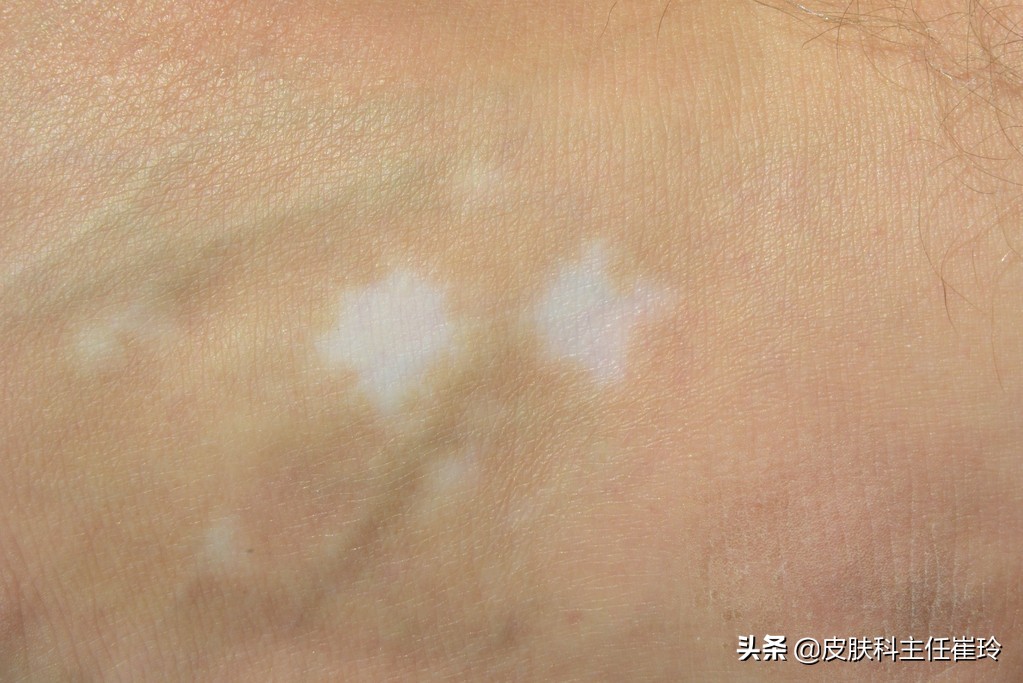 天津哪里有看白癜风的,天津什么医院看白癜风最好